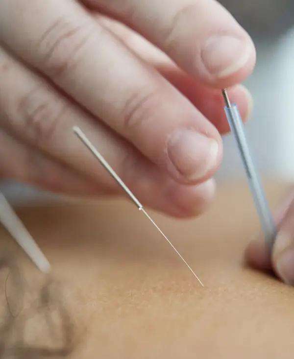 Agujas de acupuntura aplicadas en la espalda